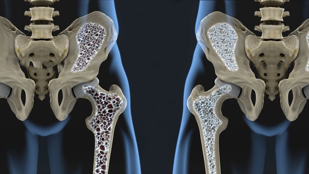 Biologics Help Maintain Bone Density in RA