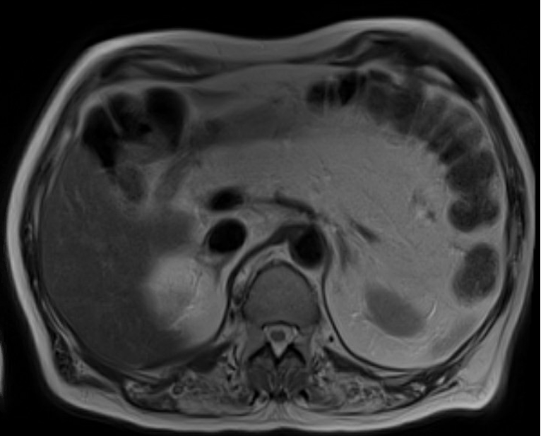 MRI showing diffuse fatty changes in the pancreas.
