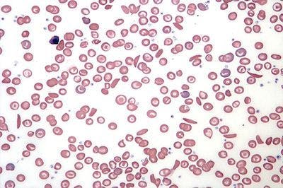 Altemia Granted Orphan Drug Designation for Treatment of Sickle Cell Disease