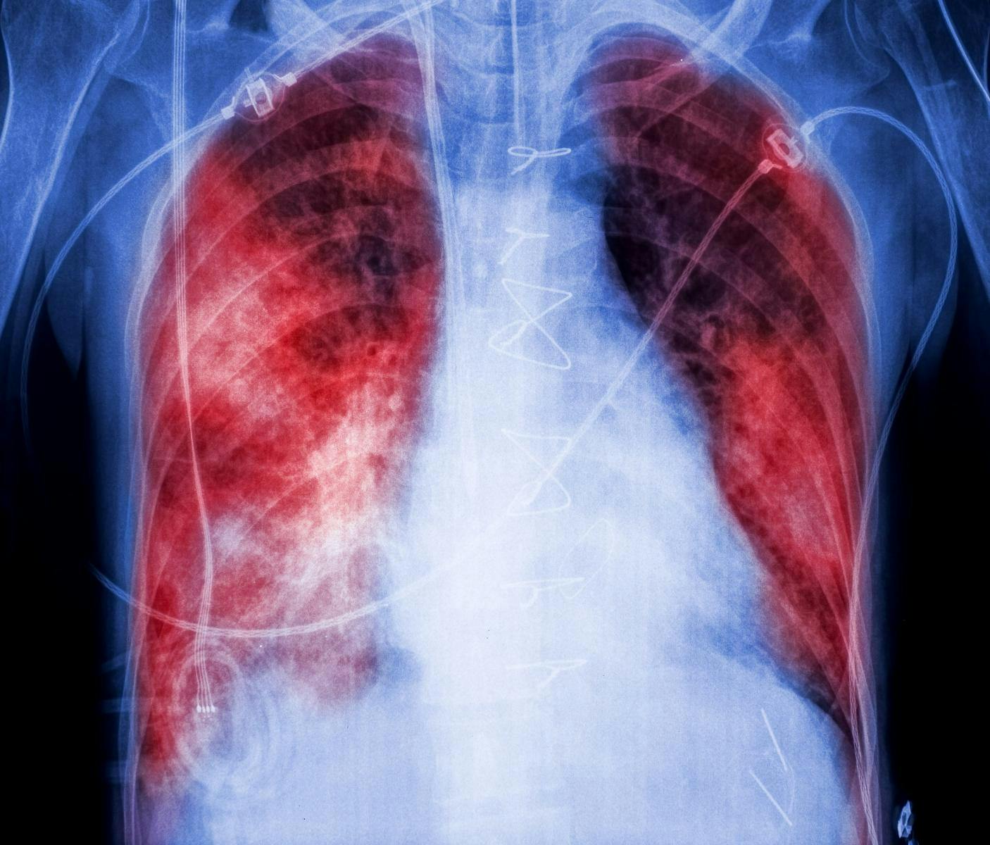 Phase 2 in Pulmonary Arterial Hypertension Fails to Meet Endpoints