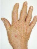Hand Pain and Swelling in a 63-Year-Old Woman