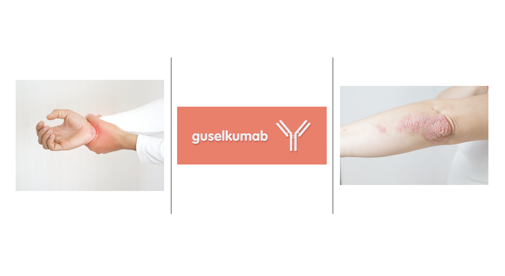 Guselkumab Sustained Long-Term Efficacy in Patients with Active Psoriatic Arthritis
