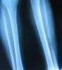 Shock-Wave Therapy for Unhealed Fractured Bones as Effective as Surgery