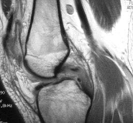 Knee Injury in a 17-Year-Old Football Player