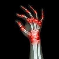 Rheumatoid Arthritis Linked to Cardiovascular Events 