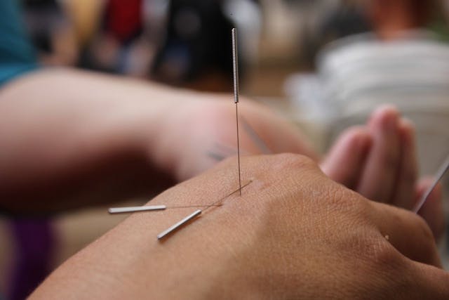 Woman receiving acupuncture in her hand | Credit: Jorge Paredes; Pixabay