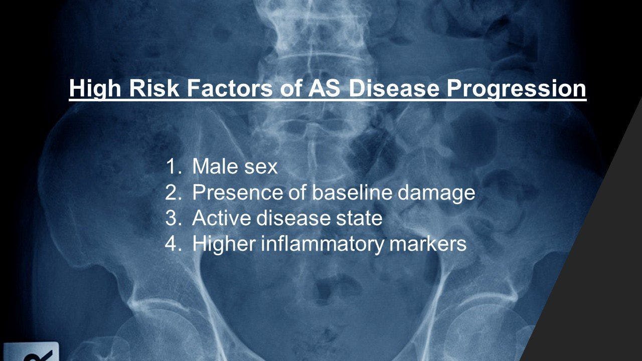 4 Factors Associated With Ankylosing Spondylitis Progression