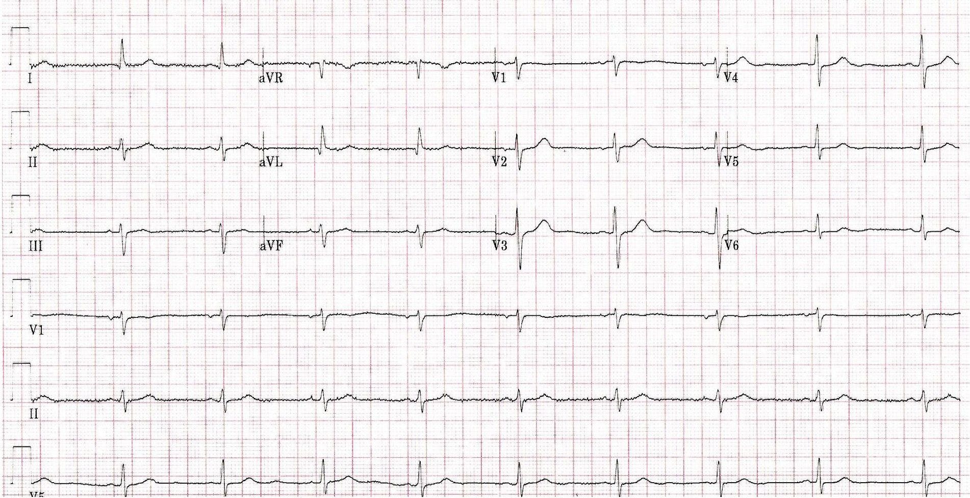 ECG printout of a patient experiencing chest pain