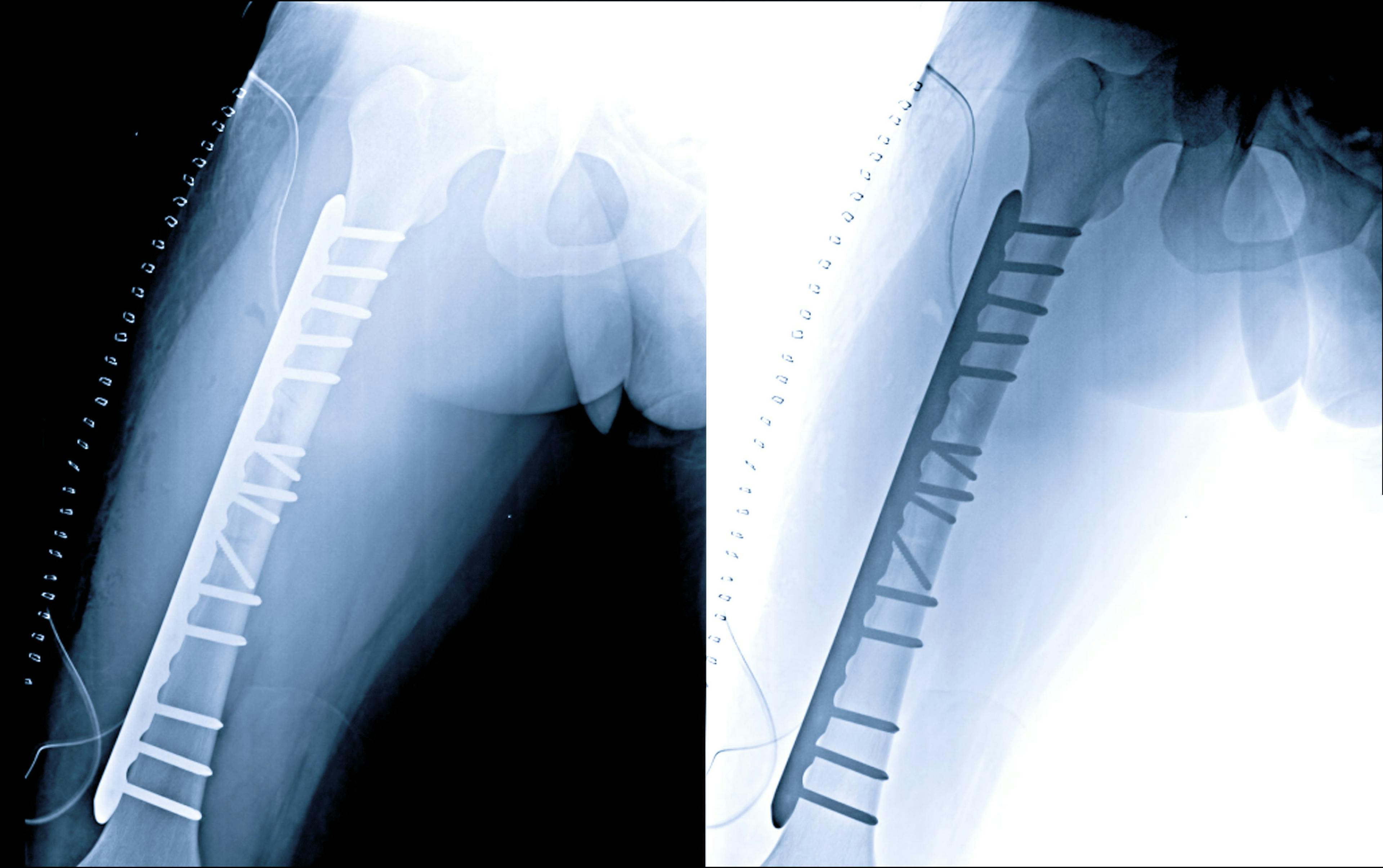 Atypical Bone Fracture Risk Rises With Bisphosphonates
