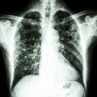 Lungs' Counter-infection Measures Highlighted  