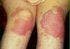 Psoriasis Linked to Higher Rates of Atherosclerosis and Death