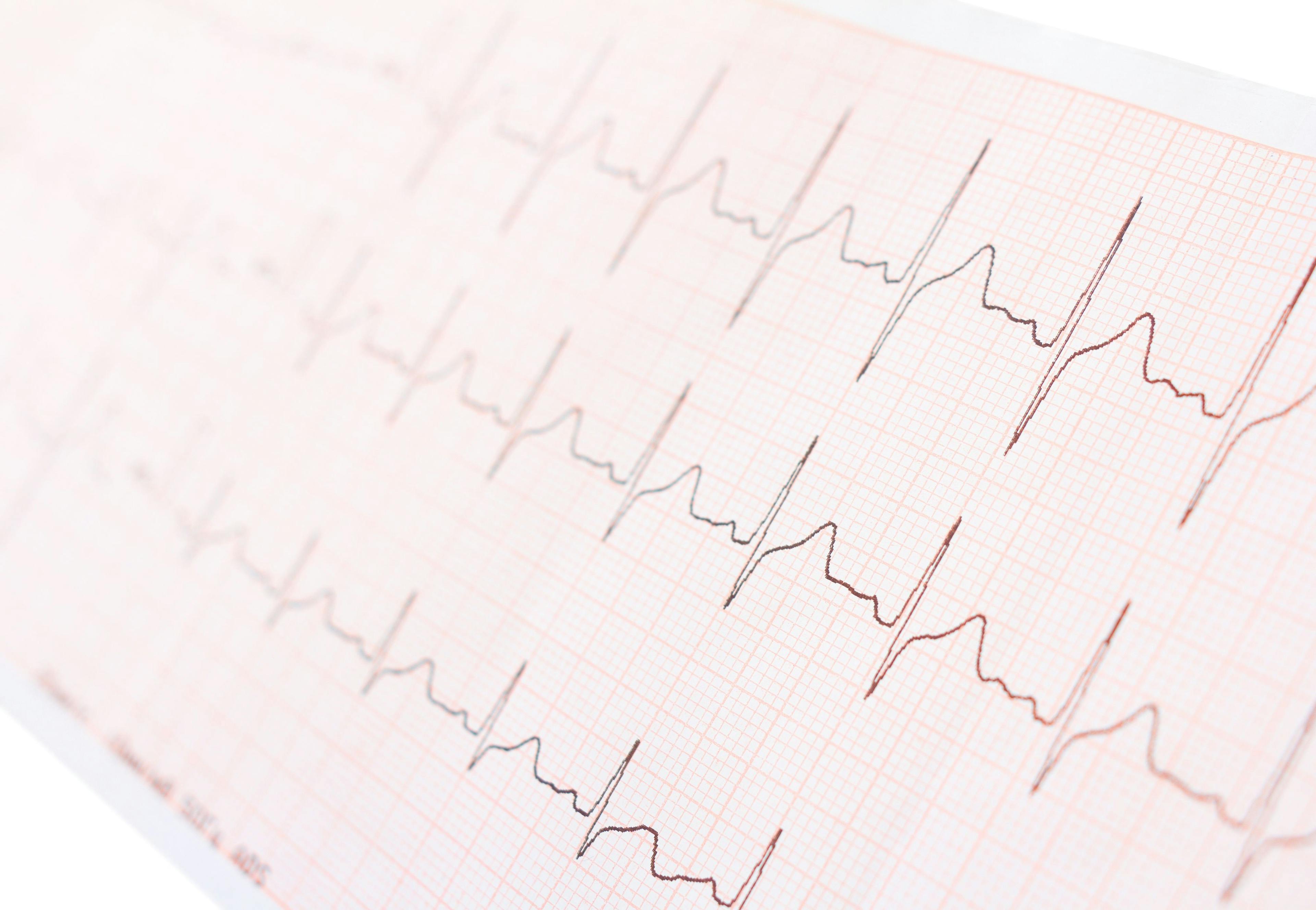 EKG displaying a normal heart rhythm
