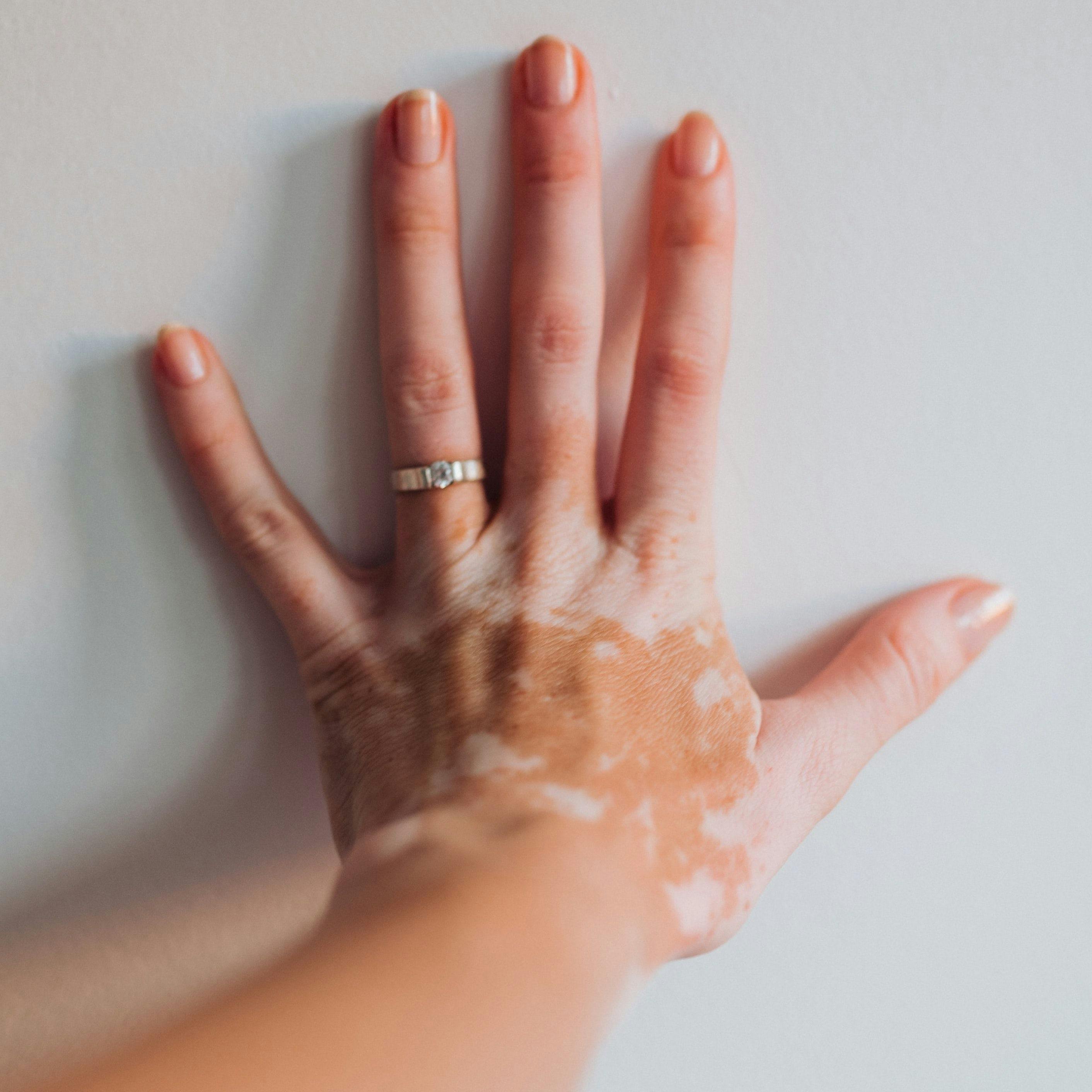 Oral Povorcitinib Significantly Improves Total, Facial Vitiligo in 24 Week Trial