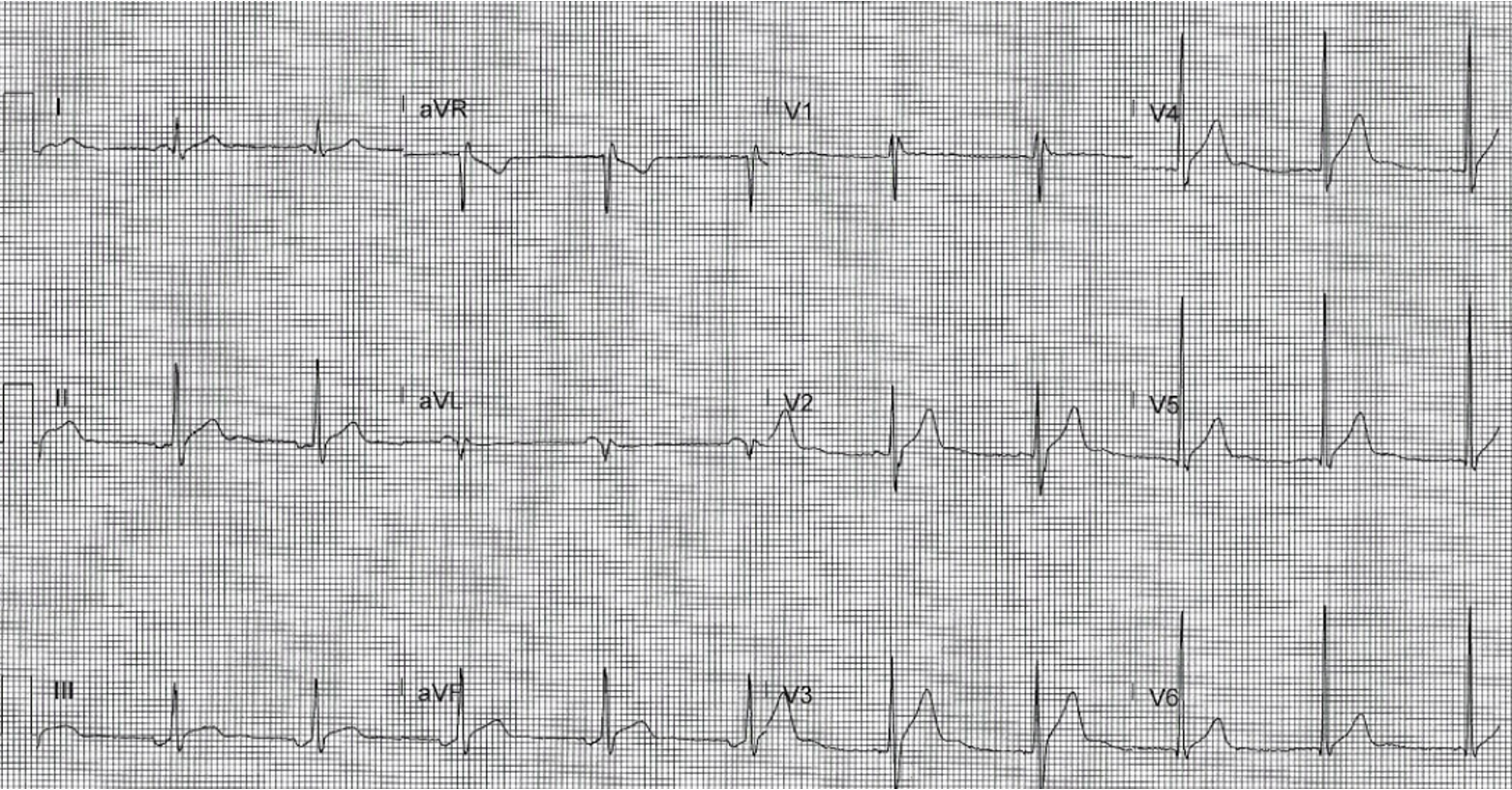 EKG of patient
