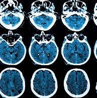 Those Deep Gray and White Matter Images Are Important in Multiple Sclerosis