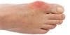 Inflammatory Cell Counts in Gout Tissues Closely Linked to Hypertension Presence