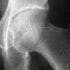 Computing Bone Fracture Risk