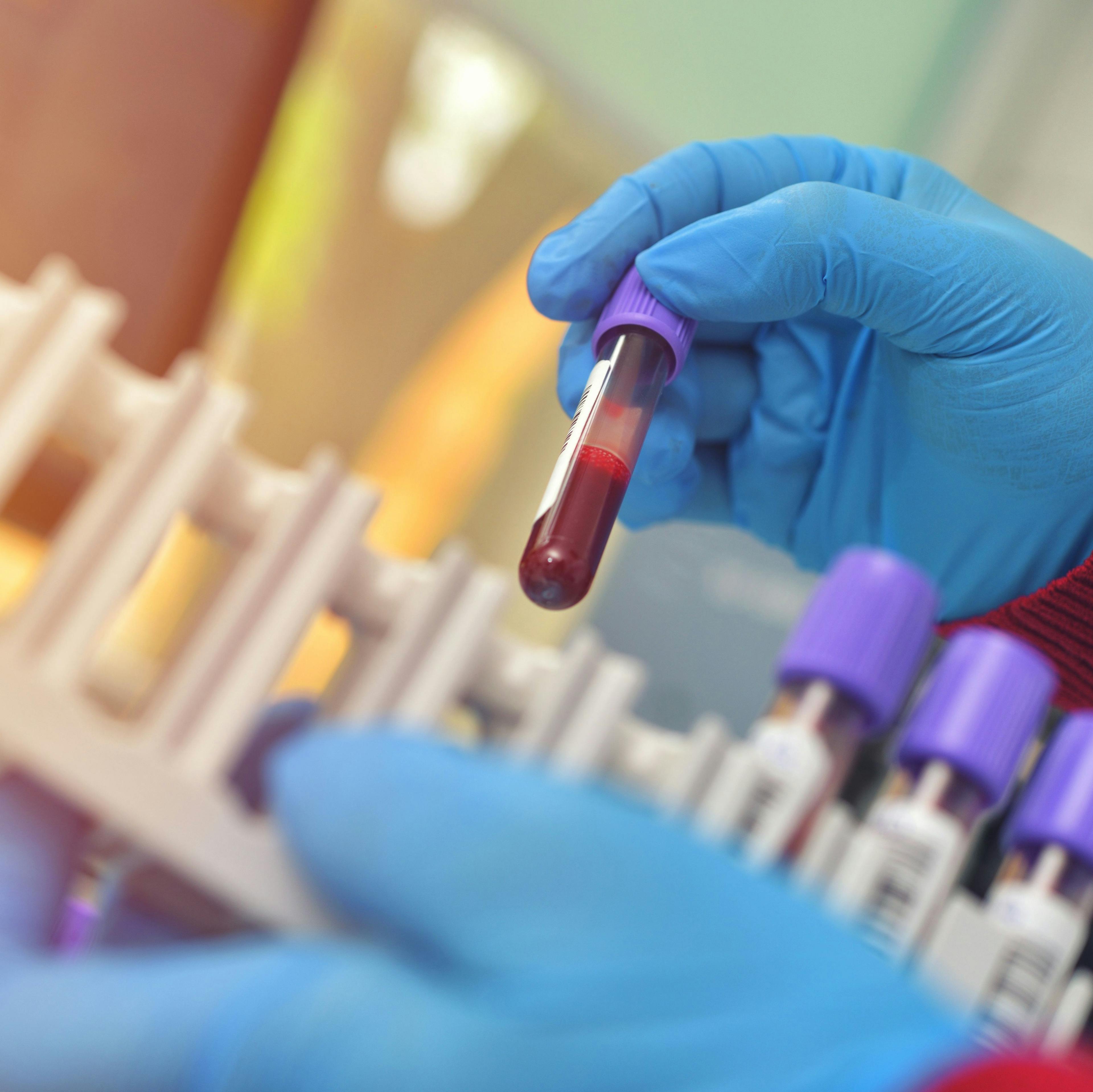 Knowledge of Severity, Susceptibility Shape Perceptions of Sickle Cell Trait Testing