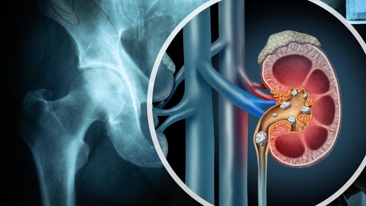 Increased Complication Rates with Kidney Injury Following Total Hip Arthroplasty