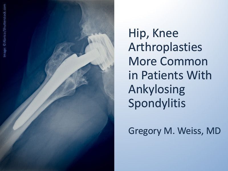 Knee, Hip Arthroplasties More Common in Older Adults With Ankylosing Spondylitis