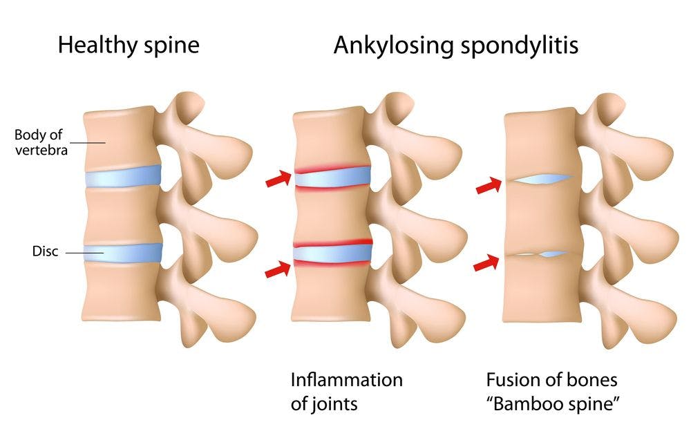 Are radiographic axSpA and ankylosing spondylitis one in the same?