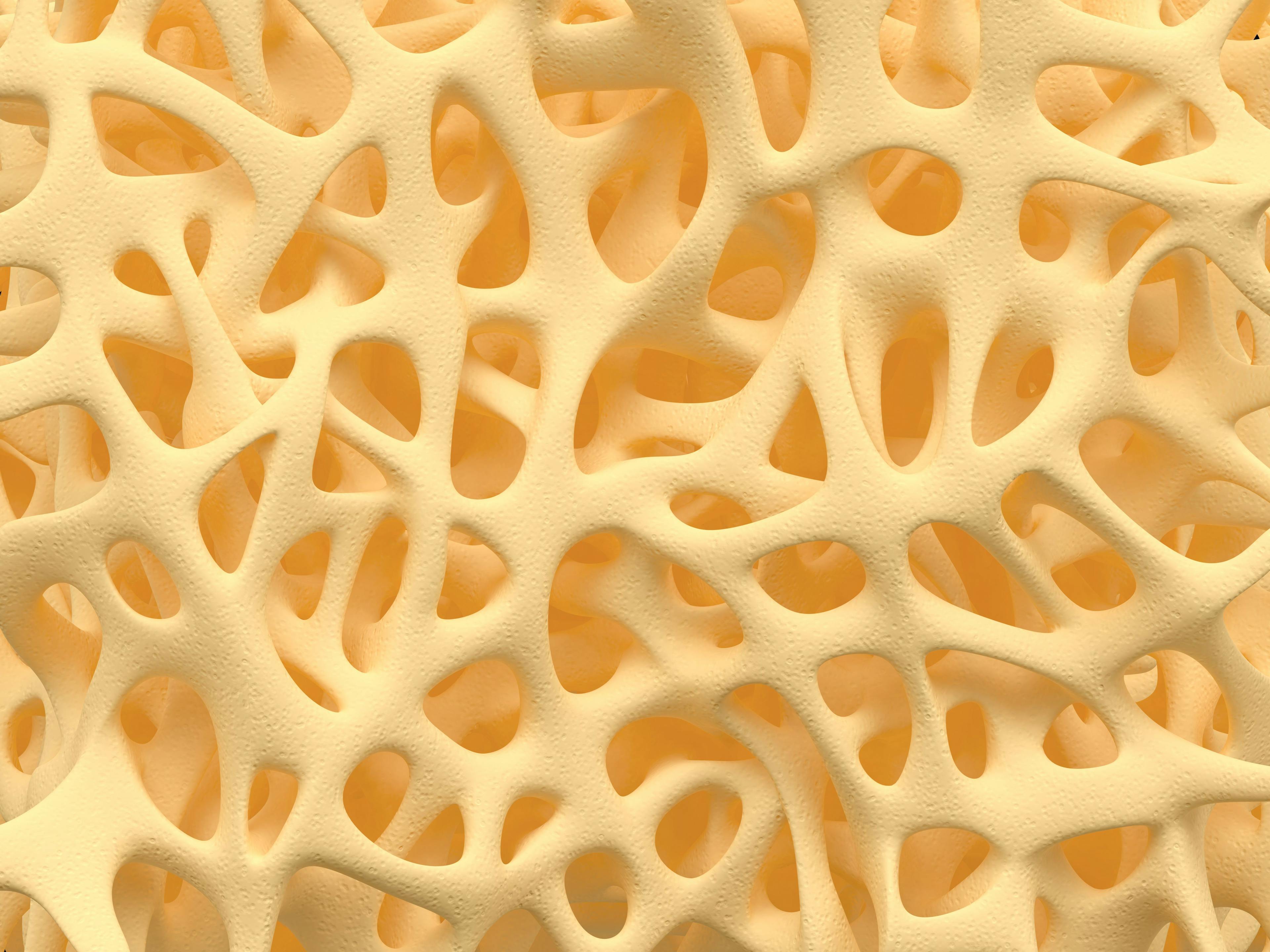 Digital illustration of bone density in osteoporosis. | Credit: Fotolia