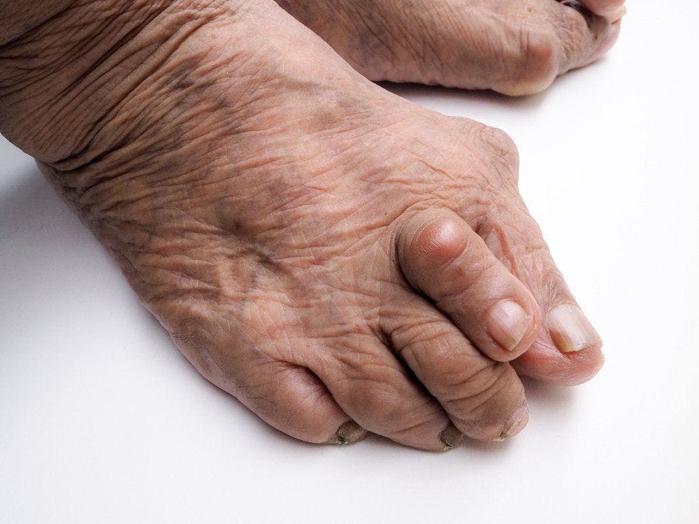 Genetic Risk Contributes to Gout Regardless of BMI Measure