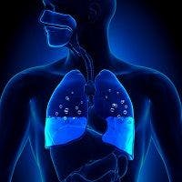 Pneumonia in Children Often Caused by Respiratory Virus