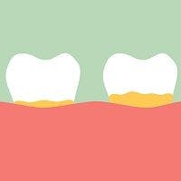 Is a Piece of the Rheumatoid Jigsaw Stuck Between Our Teeth?