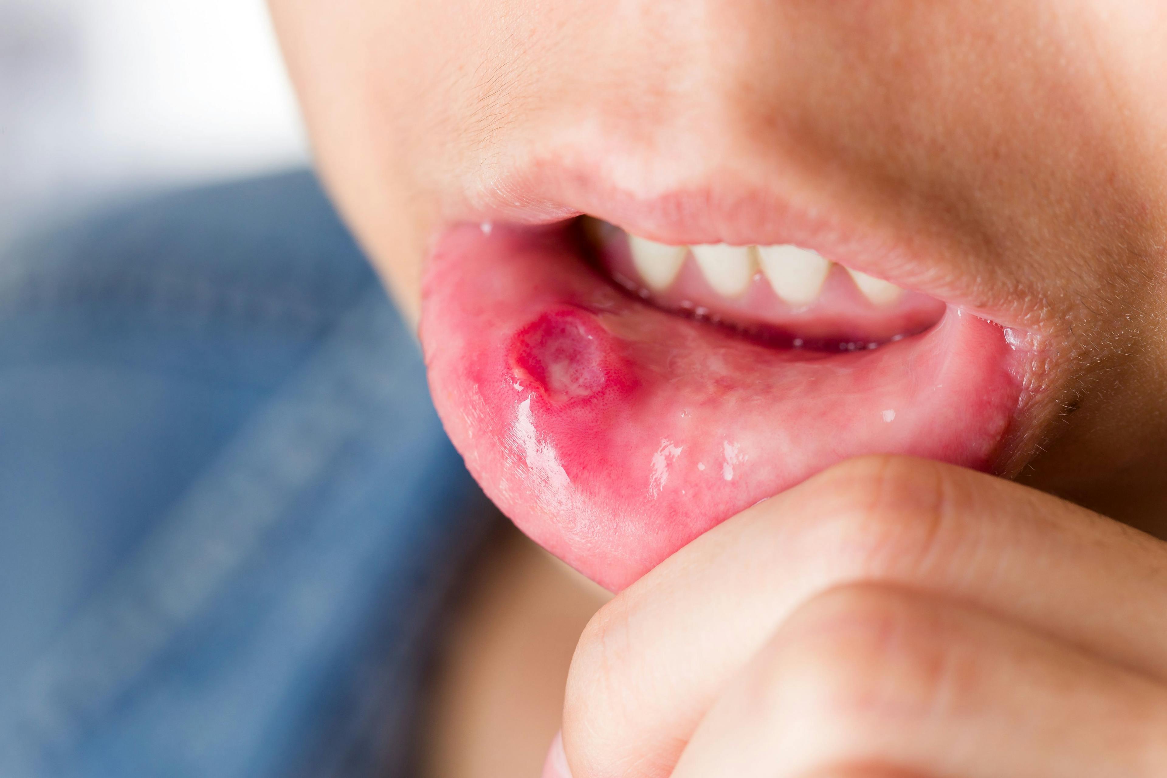 Apremilast Reduces Oral Ulcers in Behçet’s Syndrome