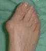 Prevalence of Bunions Increases with Age, More Common in Women