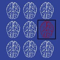 Dementia-Related Brain Changes Possibly Promoted by Critical Illnesses 