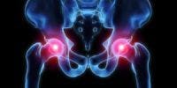 Platelet-Rich Plasma Treatment More Effective than Cortisone for Chronic Hip Bursitis 