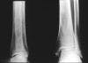 HIV-infected Postmenopausal Women at High Risk for Bone Fractures 