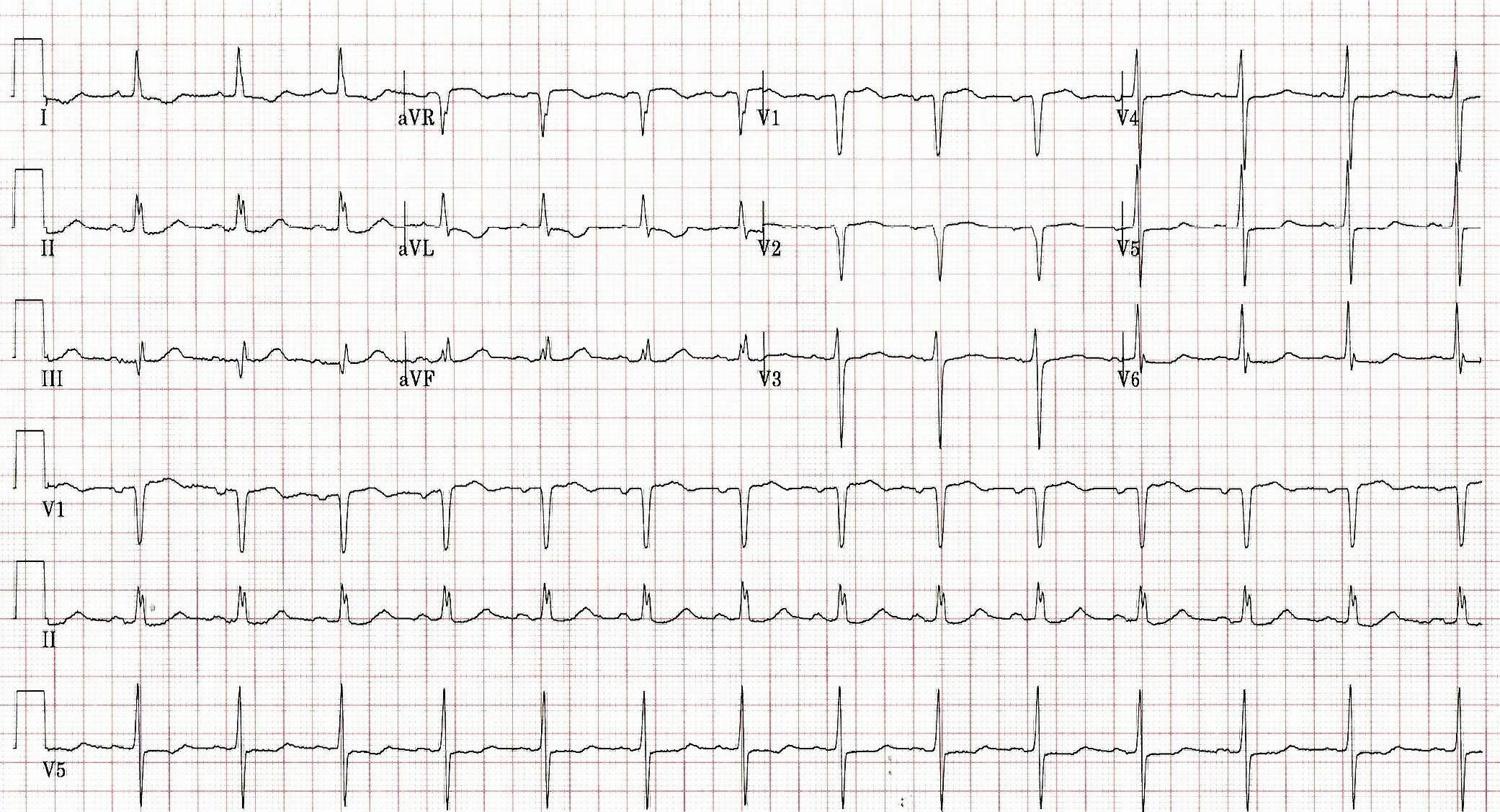 Computer Read: NSR at 85, ST & T wave abnormality, consider lateral ischemia, Prolonged QT. Credit: Brady Pregerson, MD