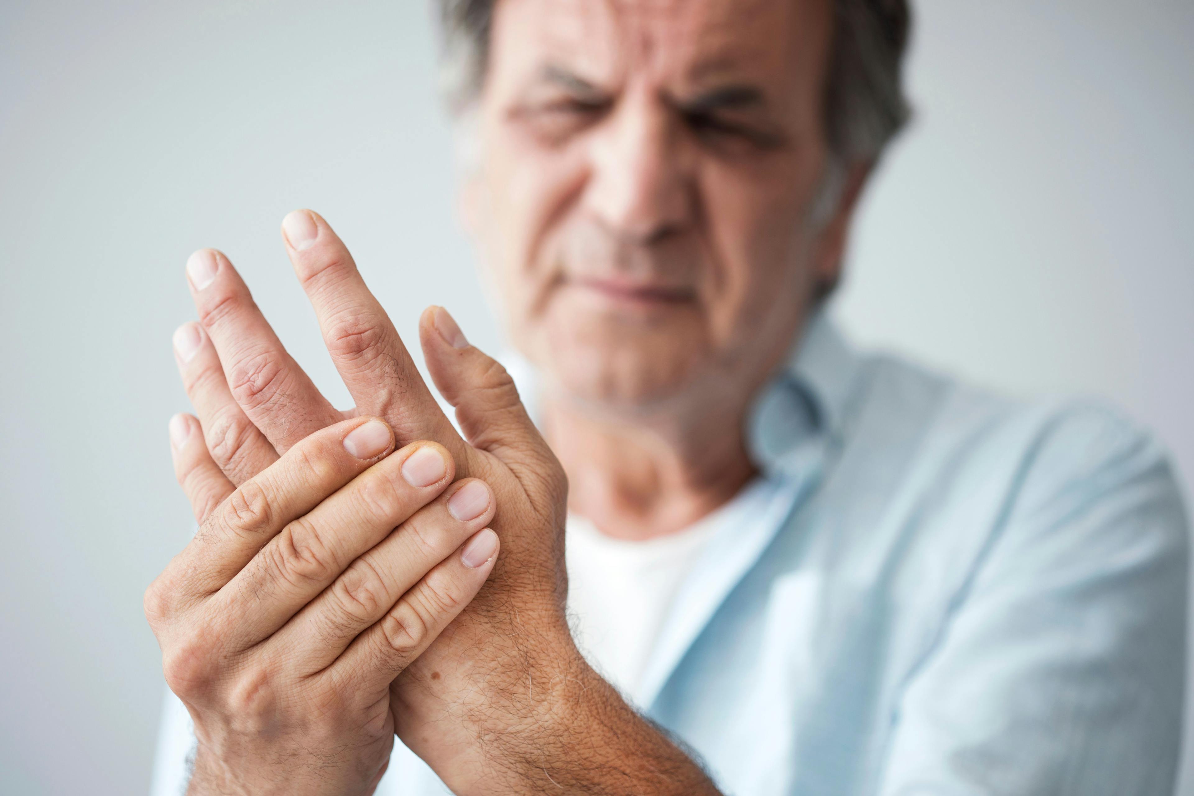 Methotrexate and/or Etanercept Improves Dactylitis, Nail Disease in Early PsA 