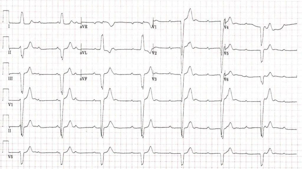 ECG print out