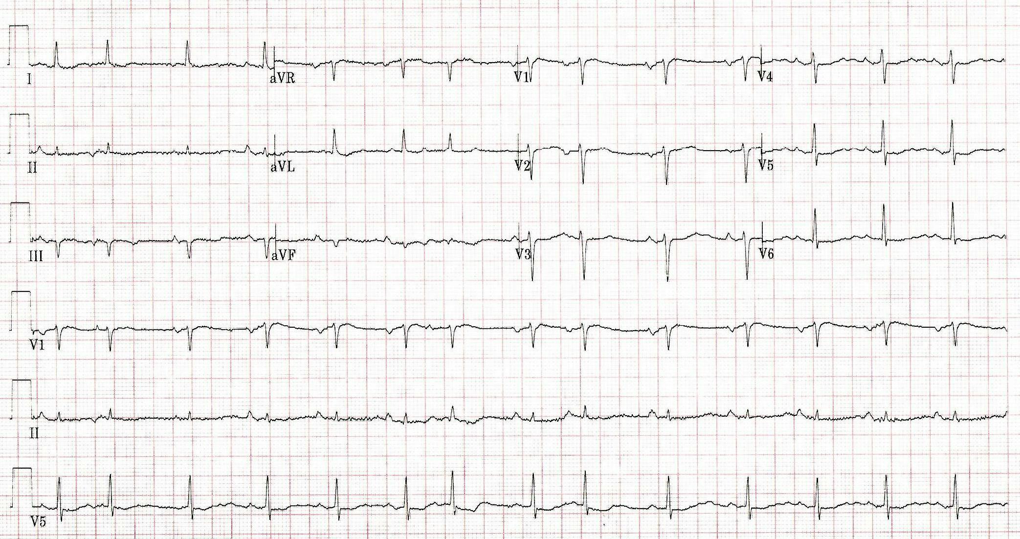 EKG of a patient experiencing palpitations.