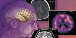 Alzheimer's Agitation Eased by Citalopram, But With Severe Adverse Effects 