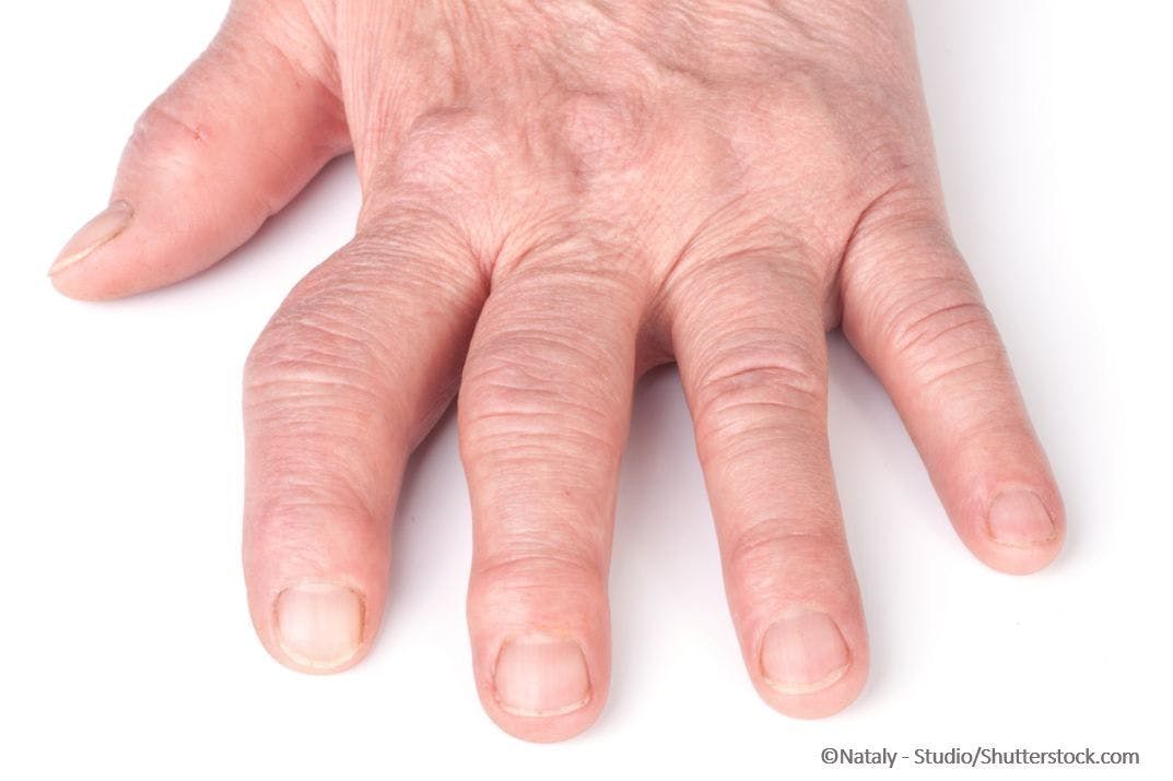 5 Questions About Rheumatoid Arthritis: A Quiz