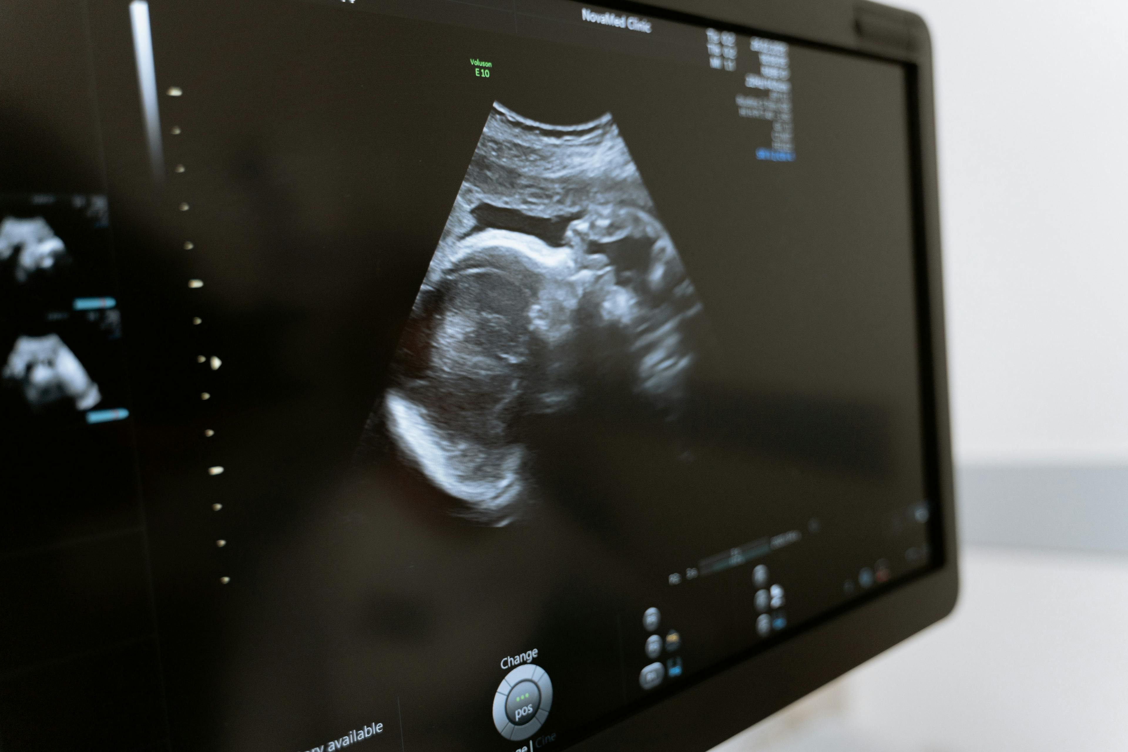 Fetus on an ultrasound | Credit: Pexels | Mart Production
