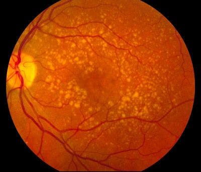 Two-Year Data Reinforces Improved Vision Outcomes with Faricimab in Wet AMD 