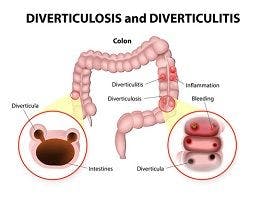 Obesity, Not Diet, Linked to Colonic Diverticula