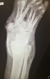 X-ray of a patient's foot