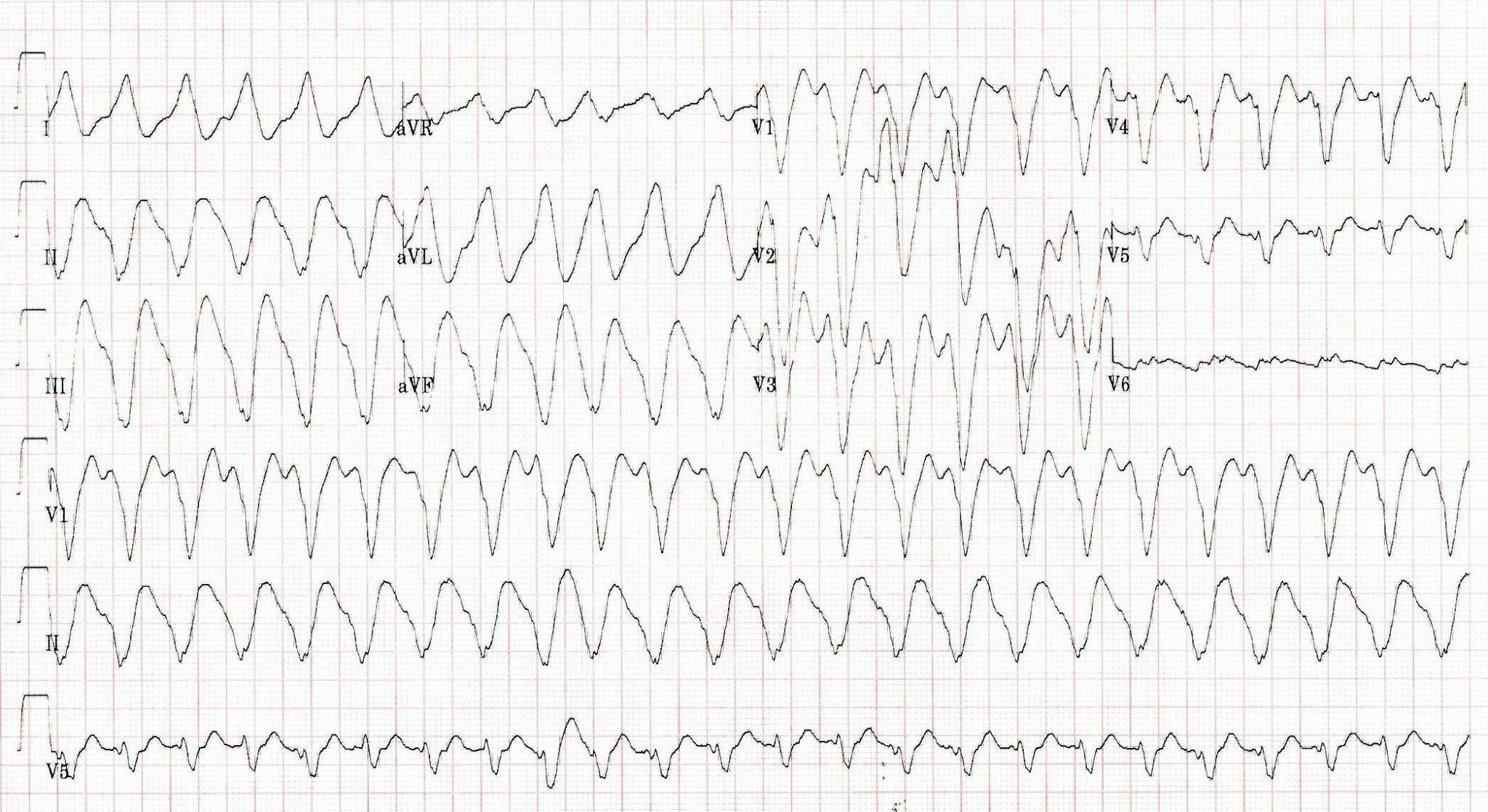 Print out of an EKG strip from a patient with chest pain.|  Credit: Brady Pregerson, MD