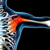 Shoulder Injury Happens Earlier Than Expected in Patients with Rheumatoid Arthritis