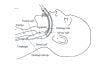 Complicated Nasal Intubation Made Easy