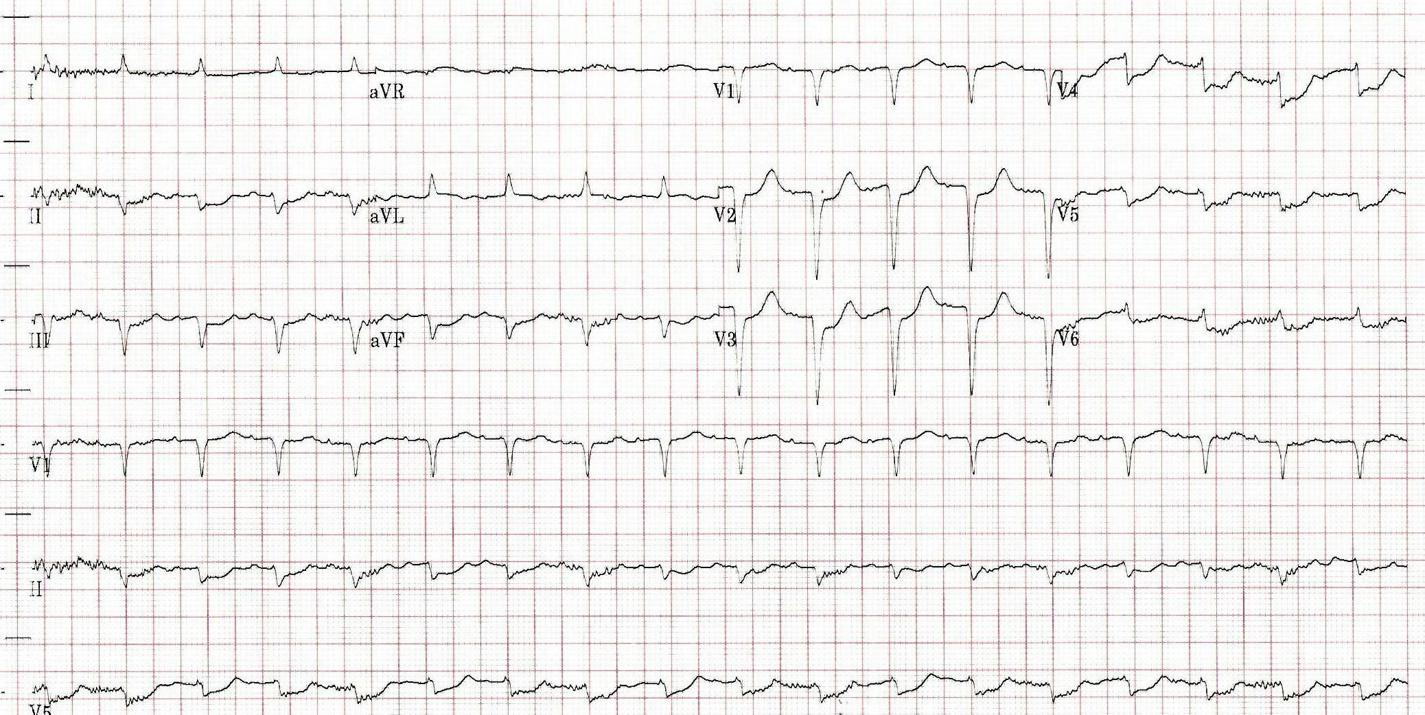 ECG of an elderly patient brought to the hospital with diabetic ketoacidosis