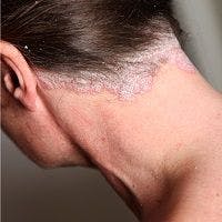 Combination Topical Steroids & Vitamin D: Effective Scalp Psoriasis Treatment