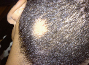 Disproportionate Effect of Alopecia Areata, Alopecia Subtypes on Asian Americans